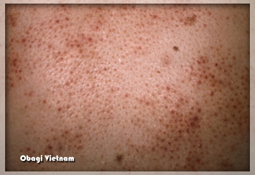 Viêm nang lông