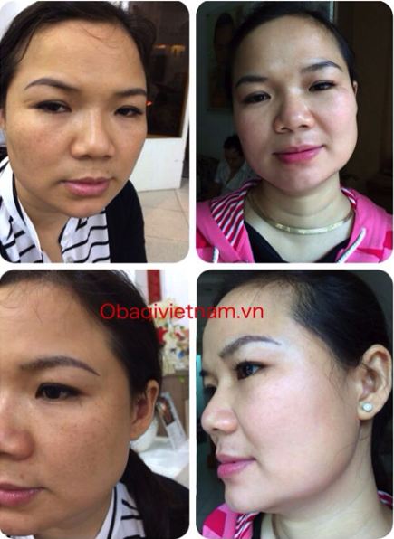 Phản hồi khách hàng trị nám Obagi Nuderm