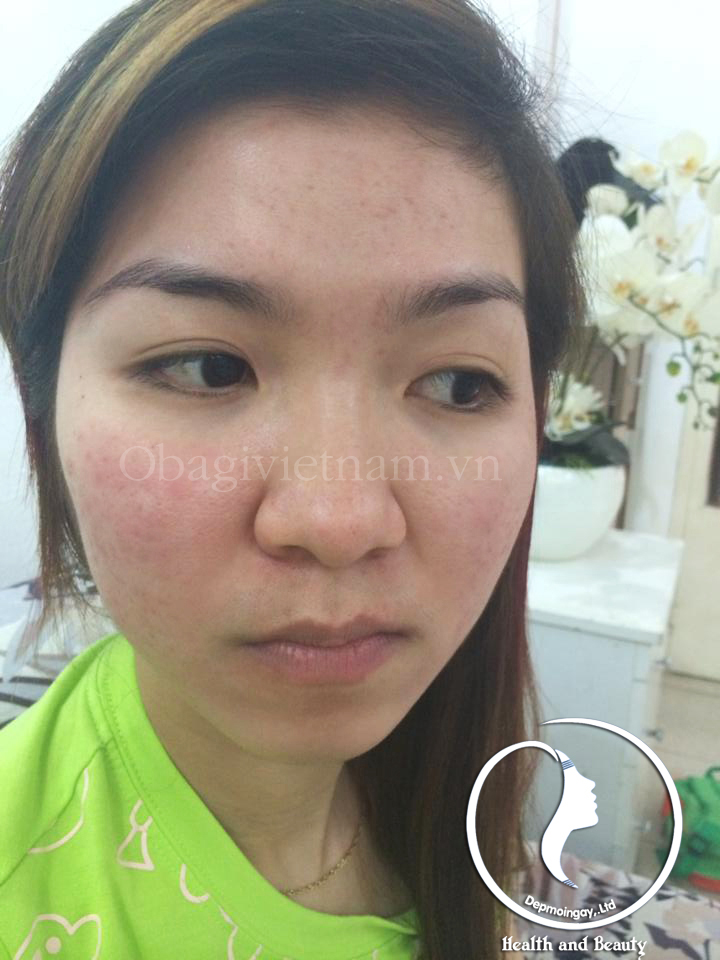 Obagi clenziderm đặc trị mụn hiệu quả. Hotline 0938449788 Tina