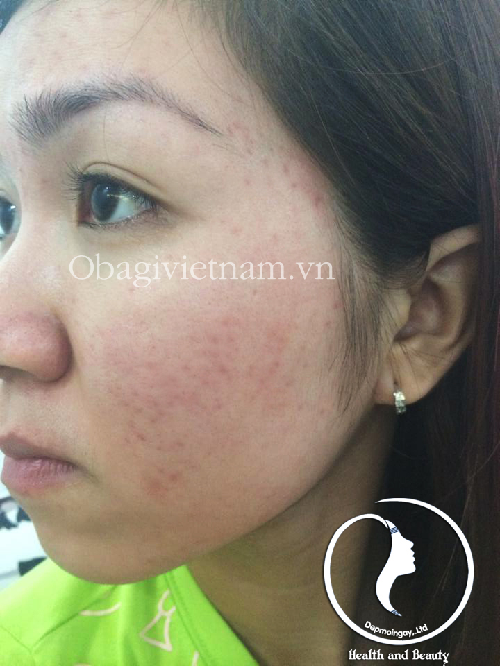 Obagi clenziderm đặc trị mụn nhanh chóng. Hotline 0938449788 Tina