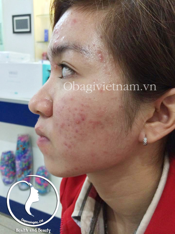 Obagi Clenziderm đặc trị mụn triệt để.Hotline 0938449788 Tina