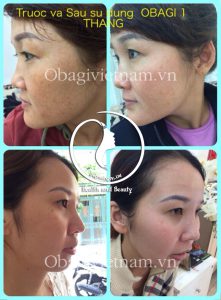 Obagi Nuderm trị nám an toàn hiệu quả. Hotline 0938449788 Tina