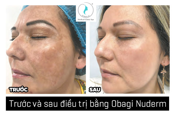 Cách sử dụng Obagi Nuderm hỗ trợ đặc trị nám hiệu quả