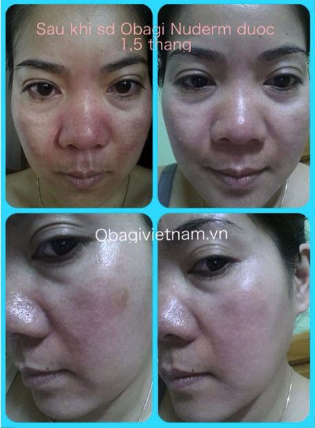 Phản hồi khách hàng trị nám Obagi Nuderm