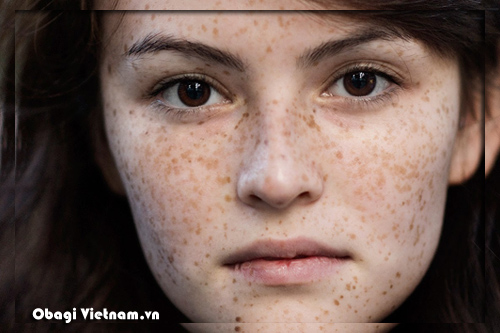 Da bị nám điều trị bằng Obagi Nuderm