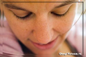Da bị tàn nhang điều trị bằng obagi Nuderm