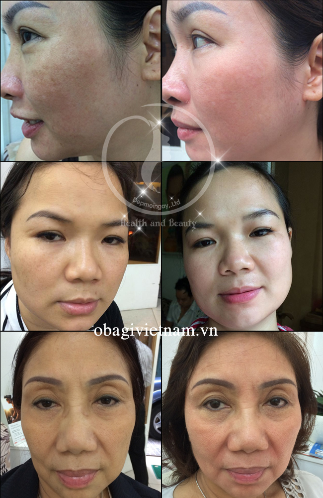 Trước và sau sử dụng Obagi Nuderm