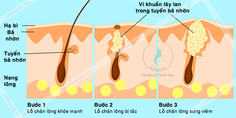 hình vi khuẩn lây lan trong tuyến bã nhờn sinh mụn viêm sưng