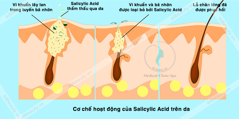 hình cơ chế hoạt động của Salicylic Acid loại bỏ vi khuẩn gây mụn