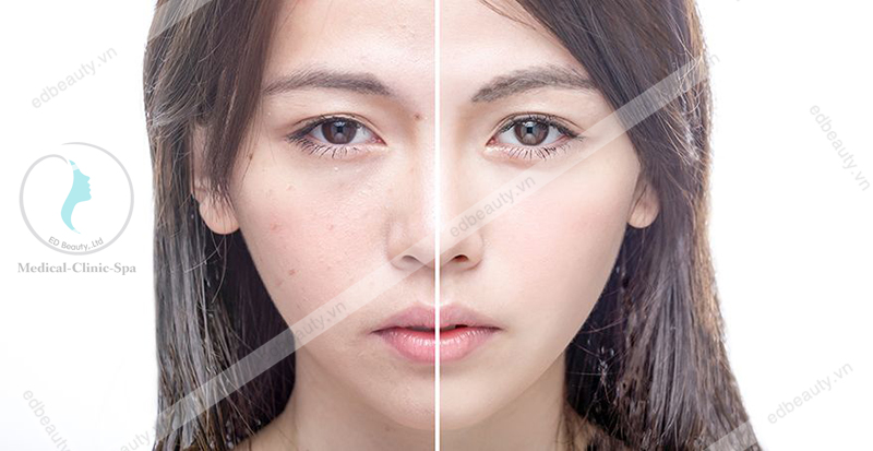hình bệnh nhân bị mụn viêm được điều trị bằng Salicylic Acid