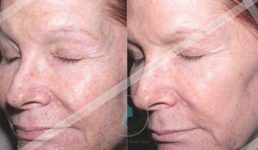 Bạn không nên sử dụng retinol tùy tiện
