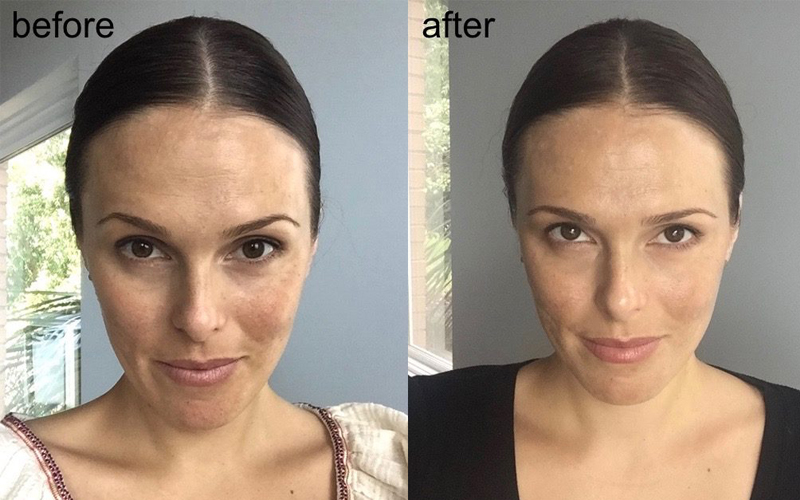 Kết quả trước và sau khi sử dụng retinol