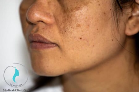 Giải quyết nám dễ dàng với kem trị nám Obagi