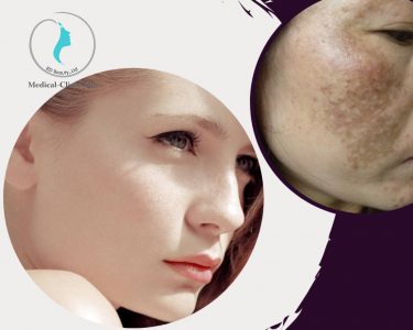 Chọn bộ trị nám và tàn nhang cần dựa vào những tiêu chí nào