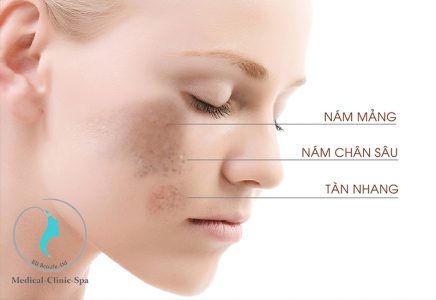 Một trong những loại Serum đặc trị nám và tàn nhang tốt nhất 2020