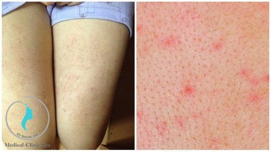 Kem dưỡng thể cho người bị bệnh dày sừng nang lông
