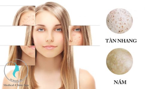 Trị nám tàn nhang obagi