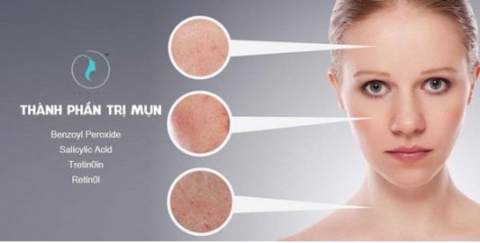 Khám phá 4 thành phần trị mụn thần thánh
