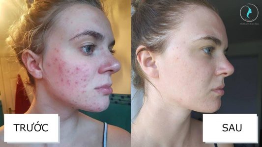 Cách sử dụng bộ đôi BHA và Retinol đúng cách và hiệu quả