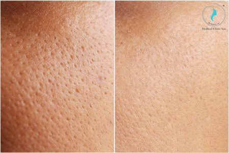 Nguyên nhân khiến lỗ chân lông to và cách khắc phục