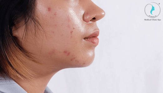 Nguyên nhân nào khiến da dầu dễ nổi mụn