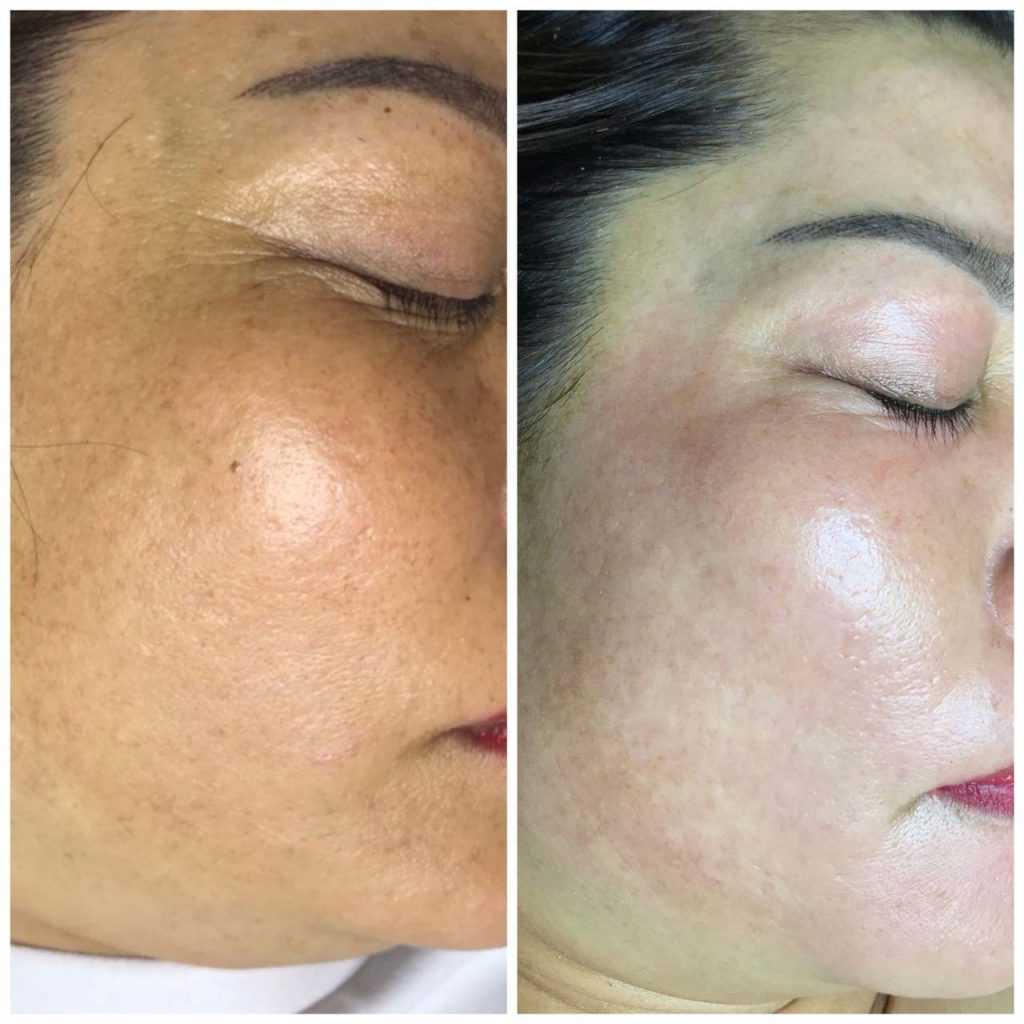 Da trắng sáng, đều màu sau khi dùng bộ 3 ZO Skin Health trị nám tàn nhang