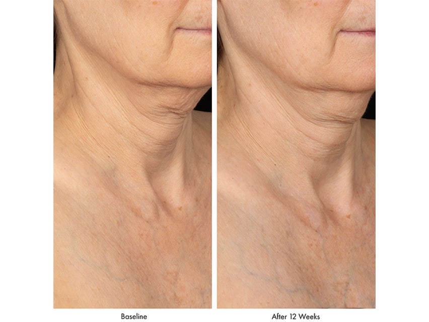 Kết quả sau 12 tuần dùng Obagi Elastiderm Neck and Décolleté Concentrate