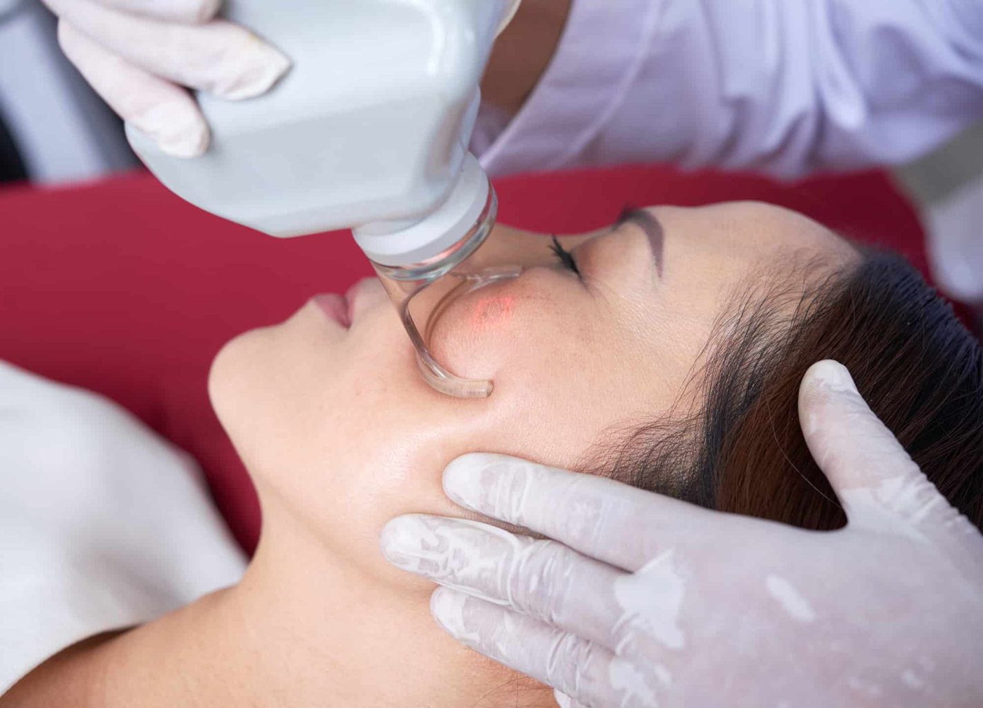 Trị sẹo mụn bằng máy