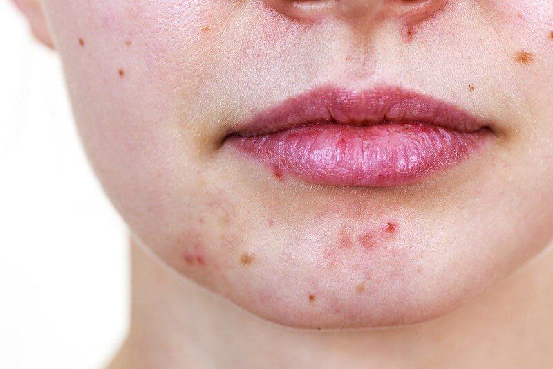 cách xử lý hiệu mụn quanh miệng