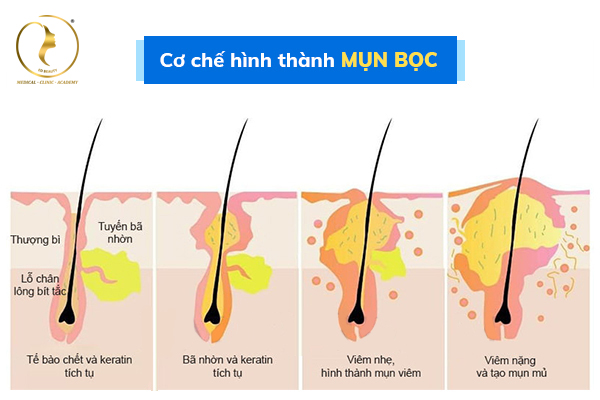 Cơ chế hình thành mụn bọc