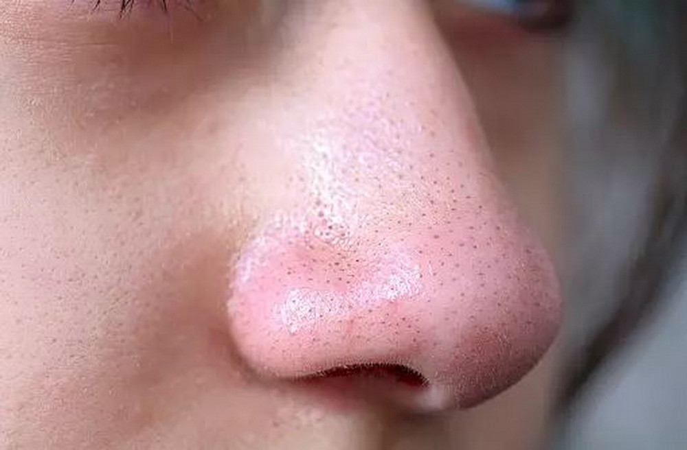 Hình: Da bị mụn đầu đen