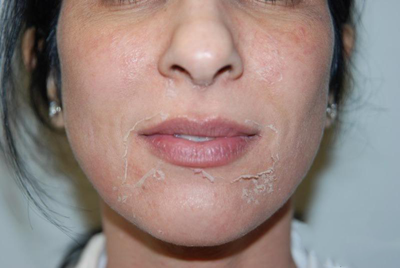 Hình: Peel da quá mạnh sẽ làm da bong tróc diện rộng