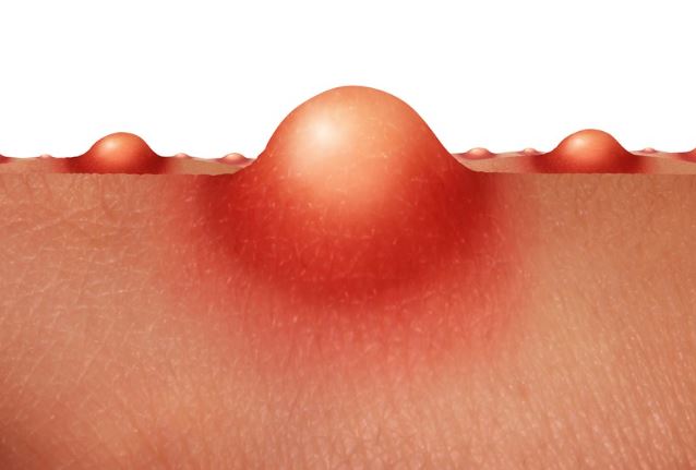 Hình: Nhận biết mụn nội tiết