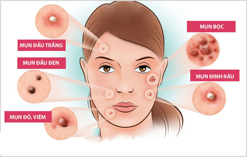 Hình: Mụn nội tiết dễ tái phát