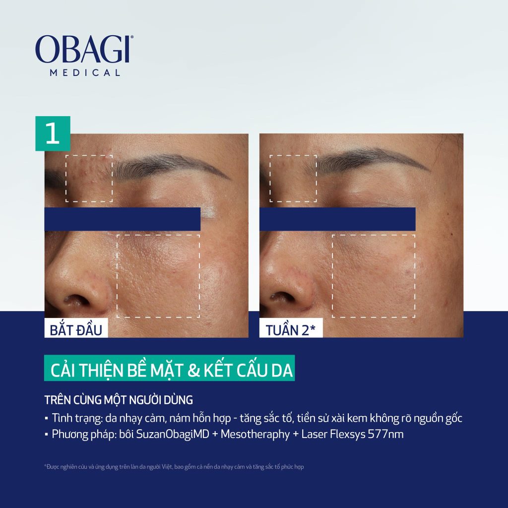 Hình: Trước và sau khi sử dụng Liệu pháp Laser – Mesotherapy