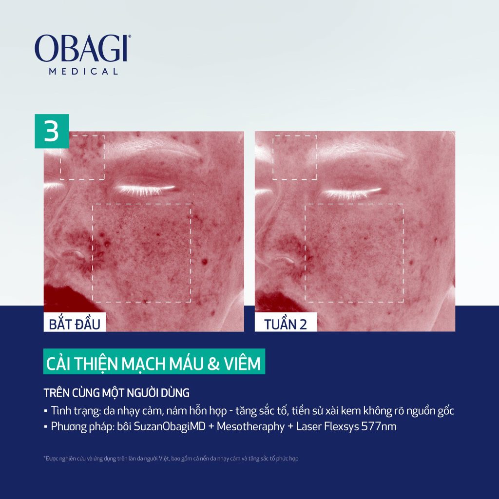 Hình: Trước và sau khi sử dụng liệu pháp Laser và Mesotherapy