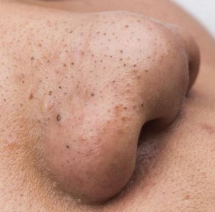 Hình: Mụn đầu đen ở mũi