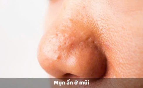 Hình: Mụn ẩn ở mũi