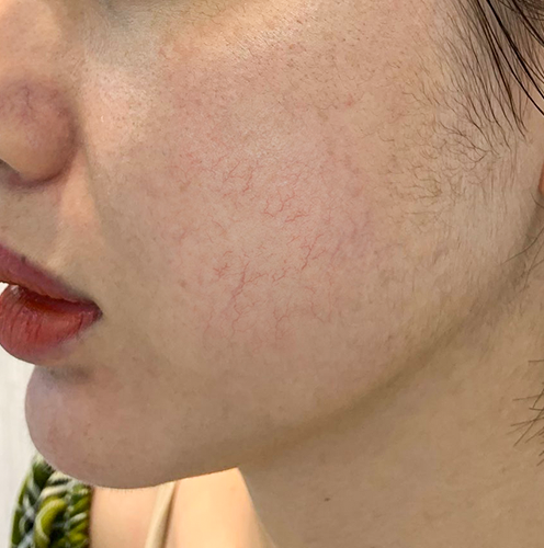 Hình: Da đang mỏng yếu và hàng rào bảo vệ bị suy giảm