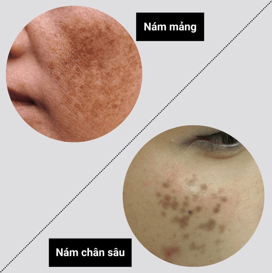 Hình: Nám chân sâu và nám nội tiết có thể không duy trì lâu dài
