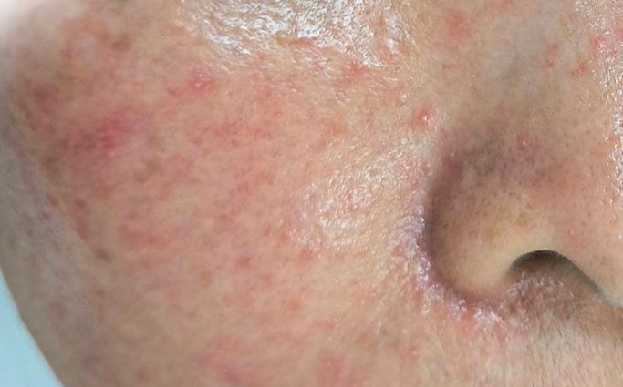 Hình: Thận trọng khi chọn laser điều trị nám da kích ứng