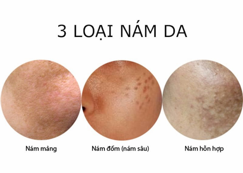 Hình: 3 loại nám da thường gặp