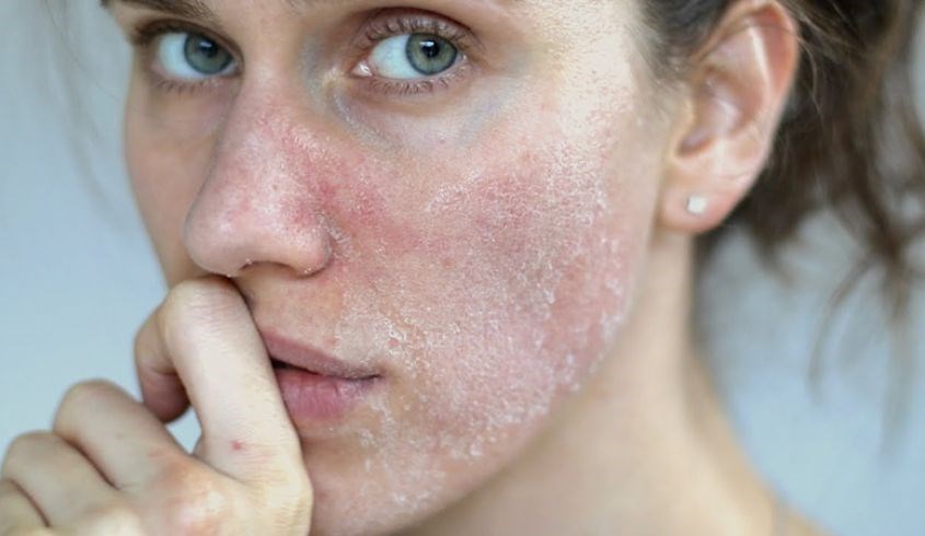 Hình: Da bị phản ứng với thành phần sữa rửa mặt