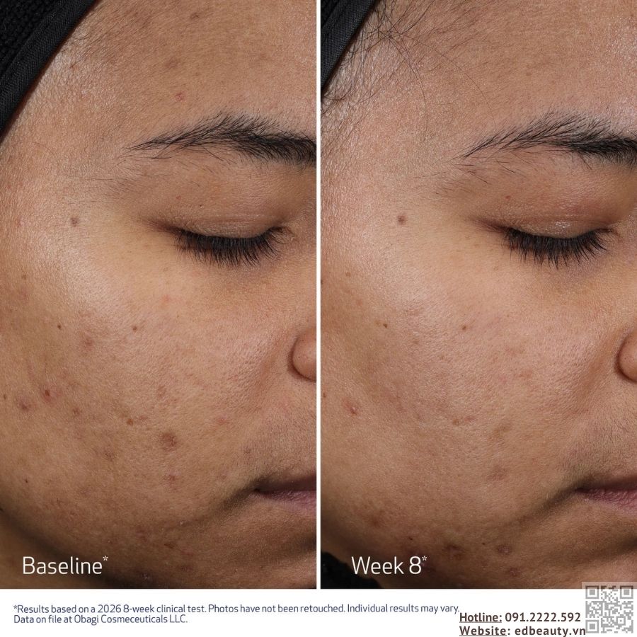 Hiệu quả khi dùng Obagi Multi-Acid Peel Pad
