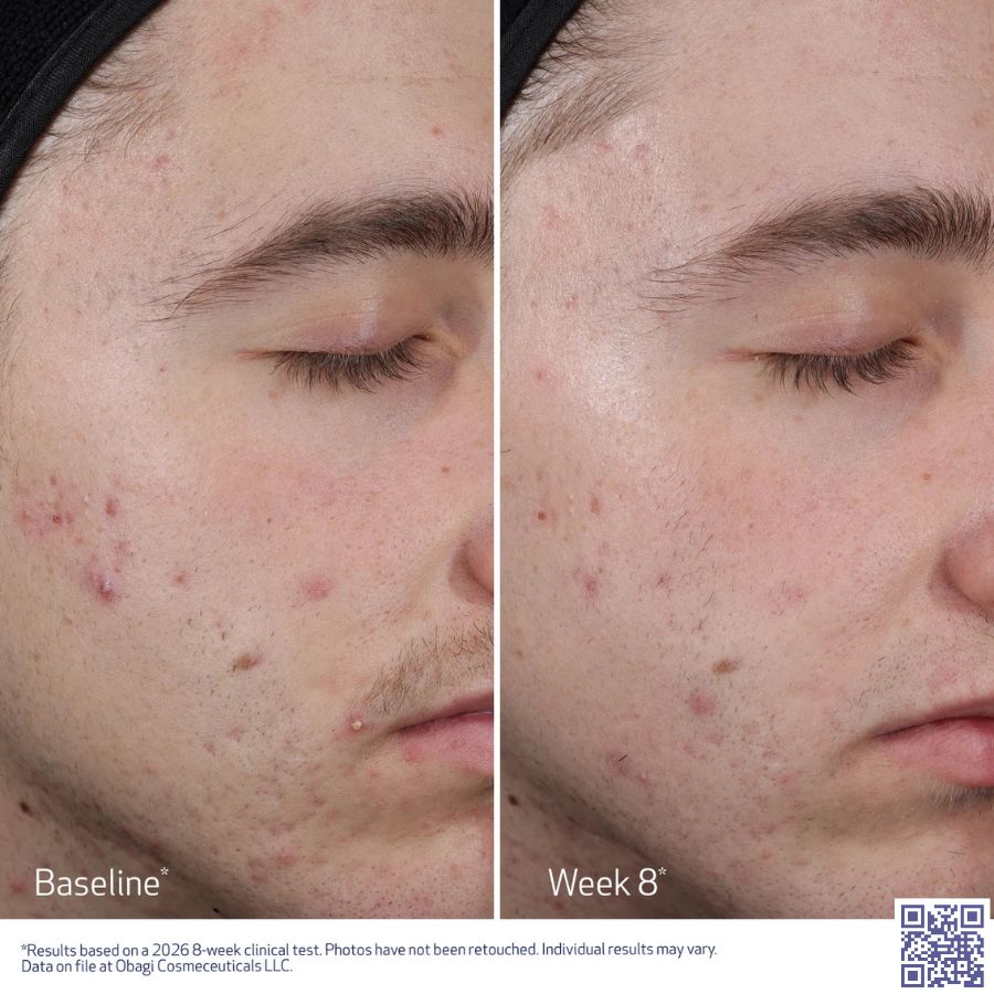 Hiệu quả khi sử dụng obagi peel acid đúng cáhc